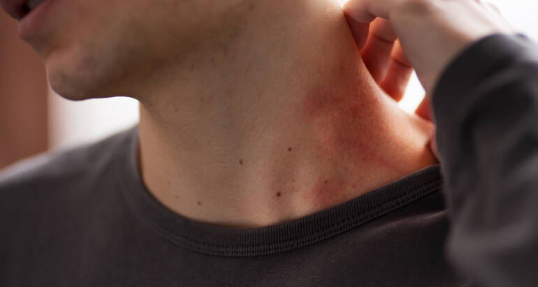 Ugryzienia pluskwy domowej – wygląd, leczenie. Jak zwalczyć pluskwy?